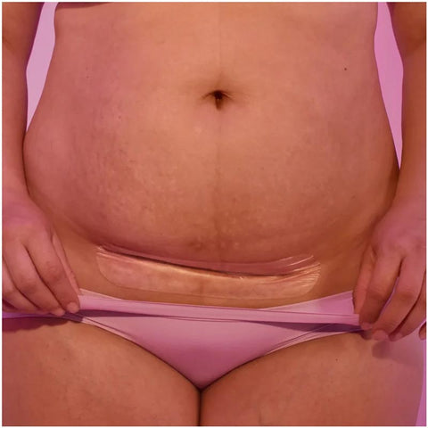 *FridaMom C-Section Silicone Scar Patches